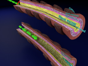 3D Asthma bronchiole obstruction model 3D Модель