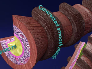 3D Asthma bronchiole obstruction model 3D Model
