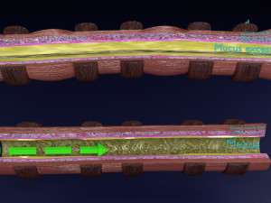 3D Asthma bronchiole obstruction model 3D 模型