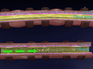 3D Asthma bronchiole obstruction model 3D Model