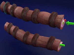3D Asthma bronchiole obstruction model 3D Model