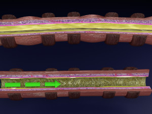 3D Asthma bronchiole obstruction model 3D 模型