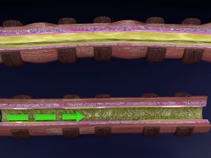 3D Asthma bronchiole obstruction model 3D Model