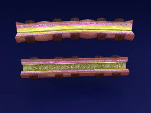 3D Asthma bronchiole obstruction model 3D Model