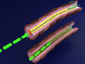 3D Asthma bronchiole obstruction model 3D Model