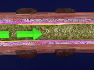 3D Asthma bronchiole obstruction model 3D 模型