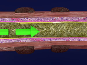 3D Asthma bronchiole obstruction model 3D Model