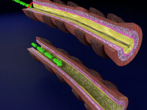 3D Asthma bronchiole obstruction model 3D Model