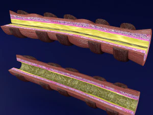 3D Asthma bronchiole obstruction model 3D Model