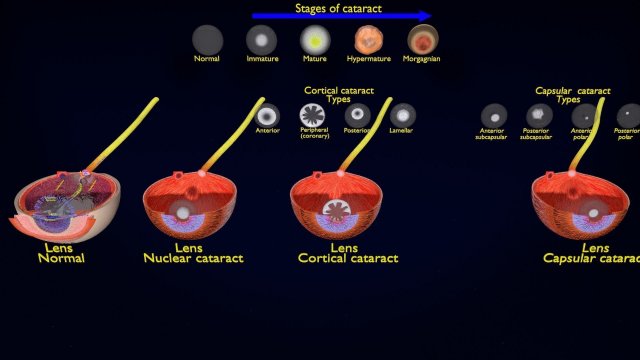 Cataract eye lens types detailed animated 3D Model .c4d .max .obj .3ds .fbx .stl .blend 