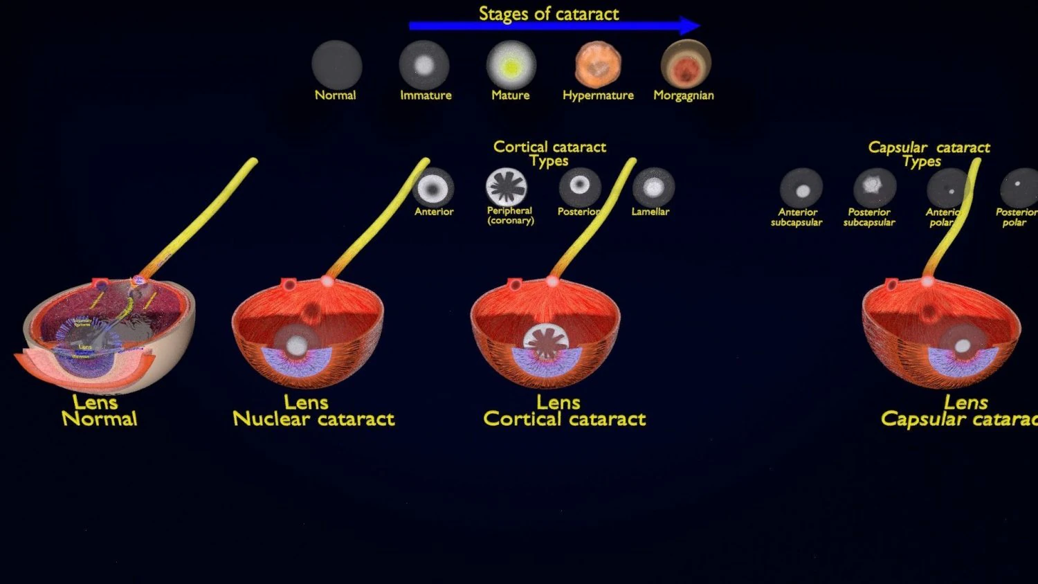 Cataract eye lens types detailed animated 3D Model .c4d .max .obj .3ds .fbx .stl .blend 