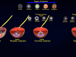 Cataract eye lens types detailed animated 3D Model