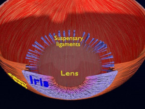 Cataract eye lens types detailed animated 3D Model