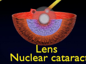 Cataract eye lens types detailed animated 3D Model