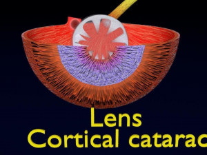 Cataract eye lens types detailed animated 3D Model