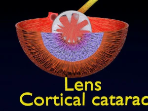 Cataract eye lens types detailed animated 3D Model