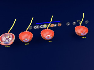 Cataract eye lens types detailed animated 3D Model