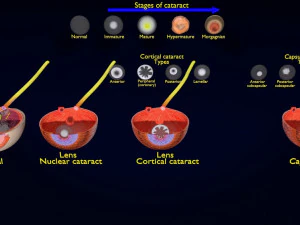 Cataract eye lens types detailed animated 3D Model