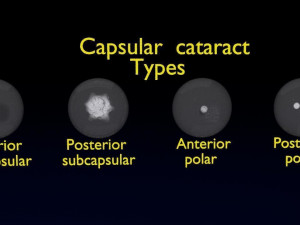 Cataract eye lens types detailed animated 3D Model