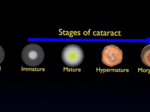 Cataract eye lens types detailed animated 3D Model