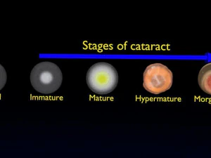 Cataract eye lens types detailed animated 3D Model