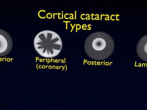 Cataract eye lens types detailed animated 3D Model