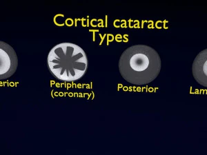 Cataract eye lens types detailed animated 3D Model