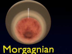 Cataract eye lens types detailed animated 3D Model