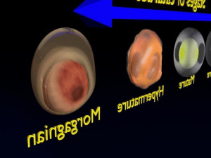 Cataract eye lens types detailed animated 3D Model
