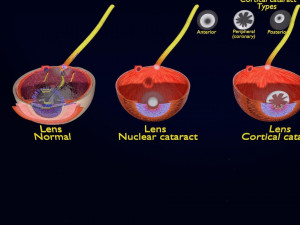Cataract eye lens types detailed animated 3D Model