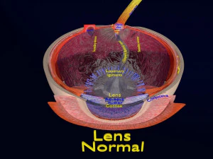Cataract eye lens types detailed animated 3D Model