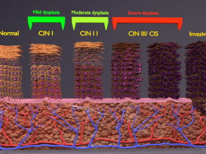 Cervical cancer dysplasia CIN Modèle 3D