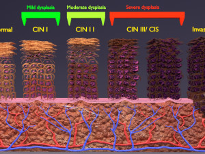 Cervical cancer dysplasia CIN Model 3D