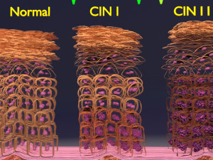 Cervical cancer dysplasia CIN Model 3D