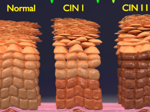 Cervical cancer dysplasia CIN Model 3D