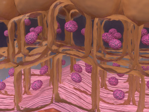 Cervical cancer dysplasia CIN Model 3D