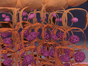 Cervical cancer dysplasia CIN Model 3D