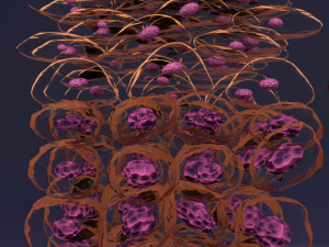 Cervical cancer dysplasia CIN Model 3D