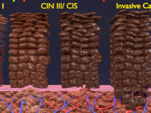 Cervical cancer dysplasia CIN Model 3D