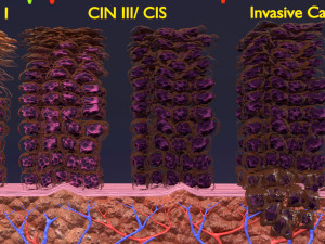 Cervical cancer dysplasia CIN Model 3D