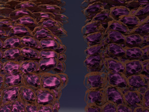 Cervical cancer dysplasia CIN Model 3D