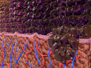 Cervical cancer dysplasia CIN Model 3D