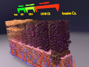 Cervical cancer dysplasia CIN Model 3D
