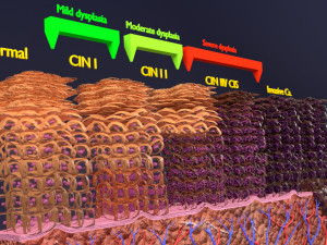 Cervical cancer dysplasia CIN Model 3D