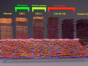Cervical cancer dysplasia CIN Model 3D