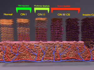 Cervical cancer dysplasia CIN Model 3D