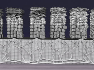 Cervical cancer dysplasia CIN Model 3D
