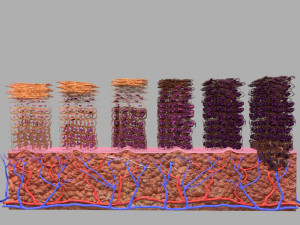 Cervical cancer dysplasia CIN Model 3D