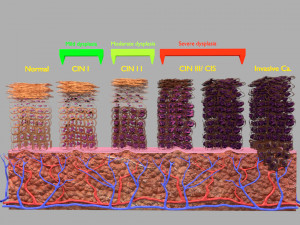 Cervical cancer dysplasia CIN Model 3D