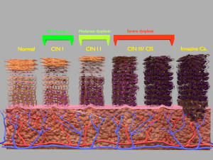 Cervical cancer dysplasia CIN Model 3D
